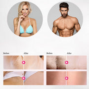 IPL Laser Hair Removal - skinnion