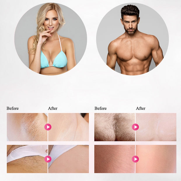 IPL Laser Hair Removal - skinnion